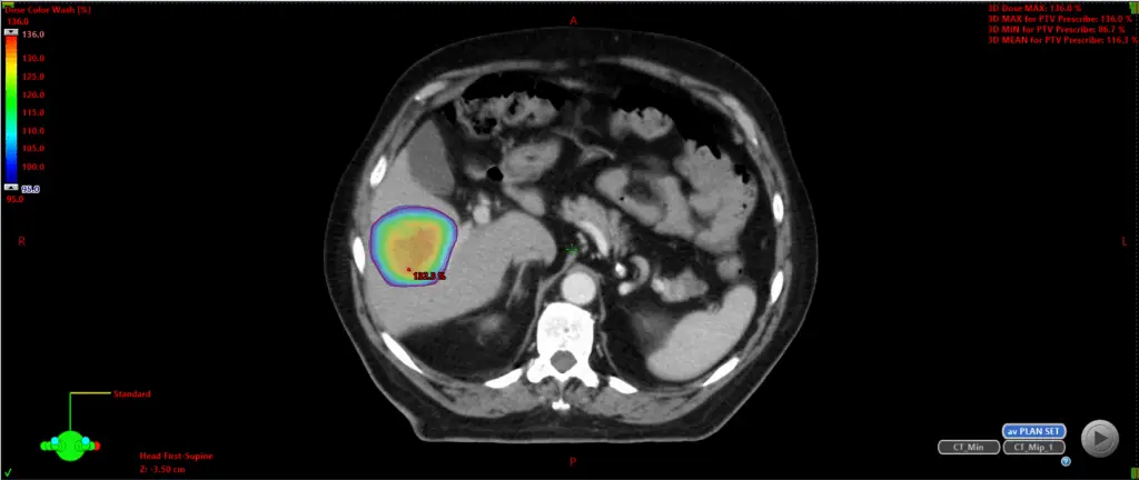 Stereotactic radiotherapy treatment for cancer patients with dr christos mikropoulos
