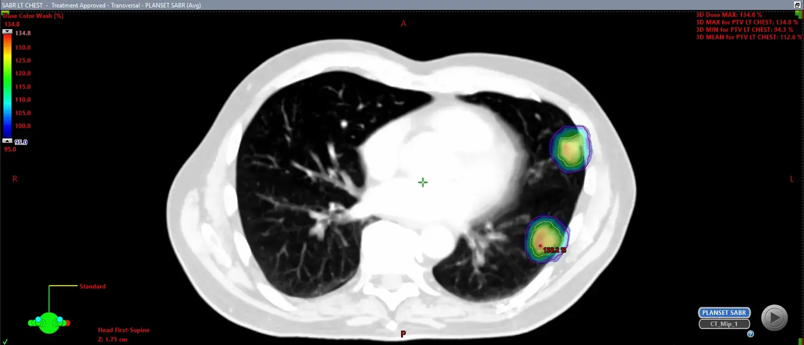 SABR radiotherapy guilford and windsor - dr christos mikropoulos